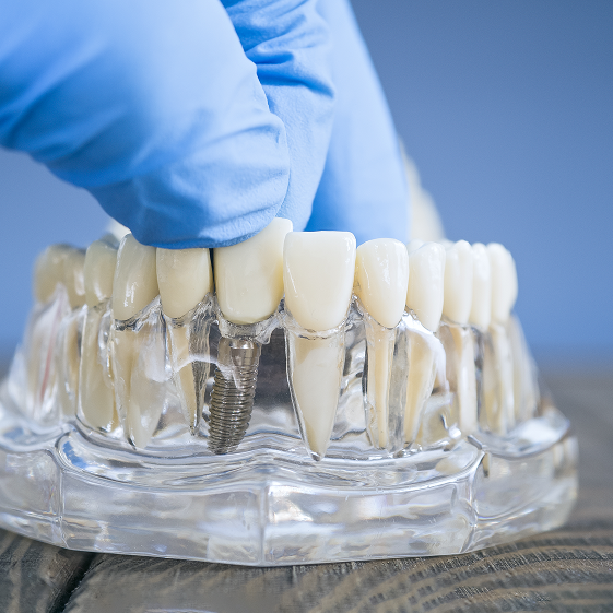 Toughest Part of Getting Dental Implants